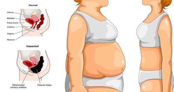What is Abdominal Bloating Causes, Remedies, and Prevention 2